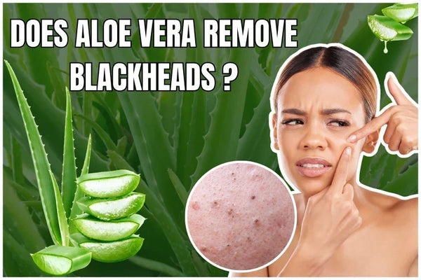 Does Aloe Vera Remove Blackheads?