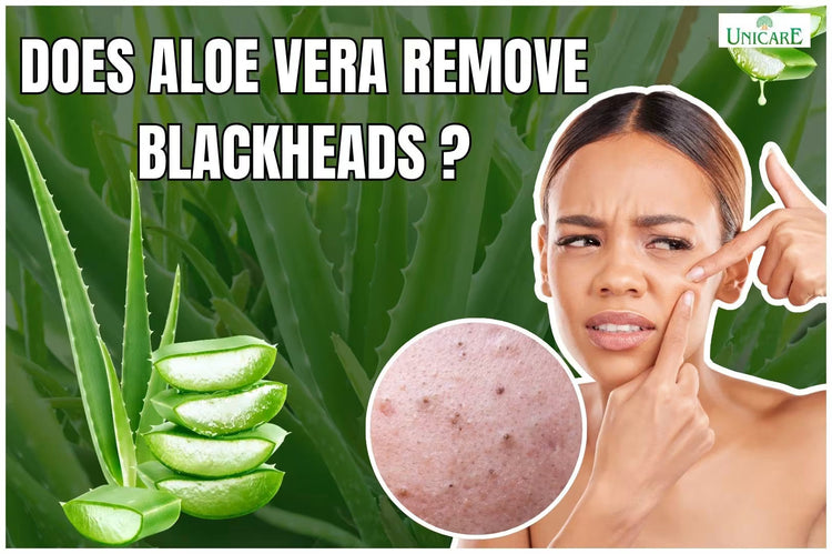 Does Aloe Vera Remove Blackheads?