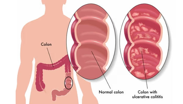 Supports recovery in ulcerative colitis