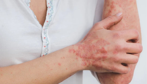 Helps in managing eczema and psoriasis.