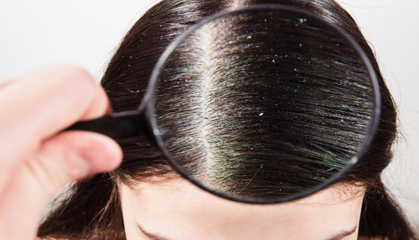 Removes Dandruff