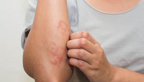 Heals Wounds & Skin Diseases