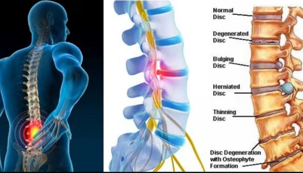 Helps relieve spondylosis and spondylitis symptoms